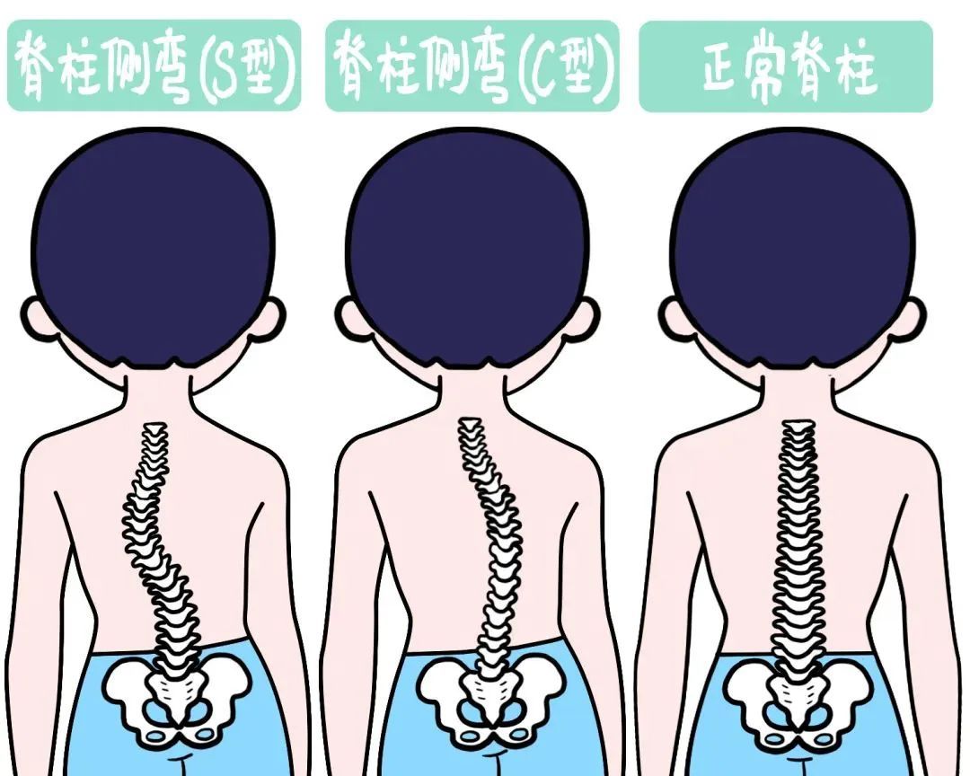 孩子“坐没坐相”可能是脊柱侧弯孩子坐没坐相警惕可能是脊柱侧弯，家长必看！