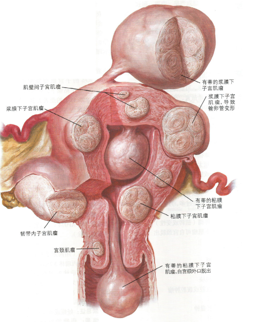 子宫肌瘤进入宫腔后果怎样子宫肌瘤进入宫腔后果分析